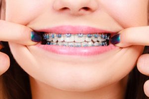 Alambre trenzado en ortodoncia - Clínica Dental Everest